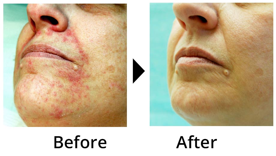 facial-eczema.jpg