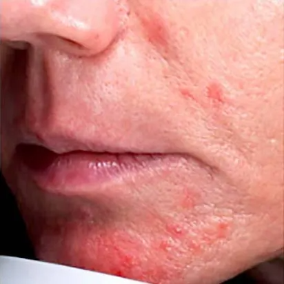 facial-eczema.jpg